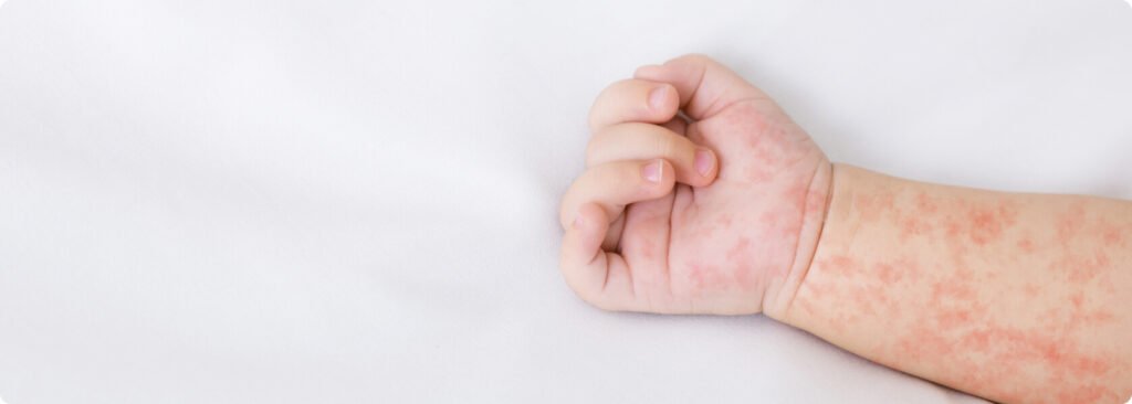 Ringelröteln wie lange ansteckend – Dauer, Risiken und wichtige Fakten ringelröteln wie lange ansteckend